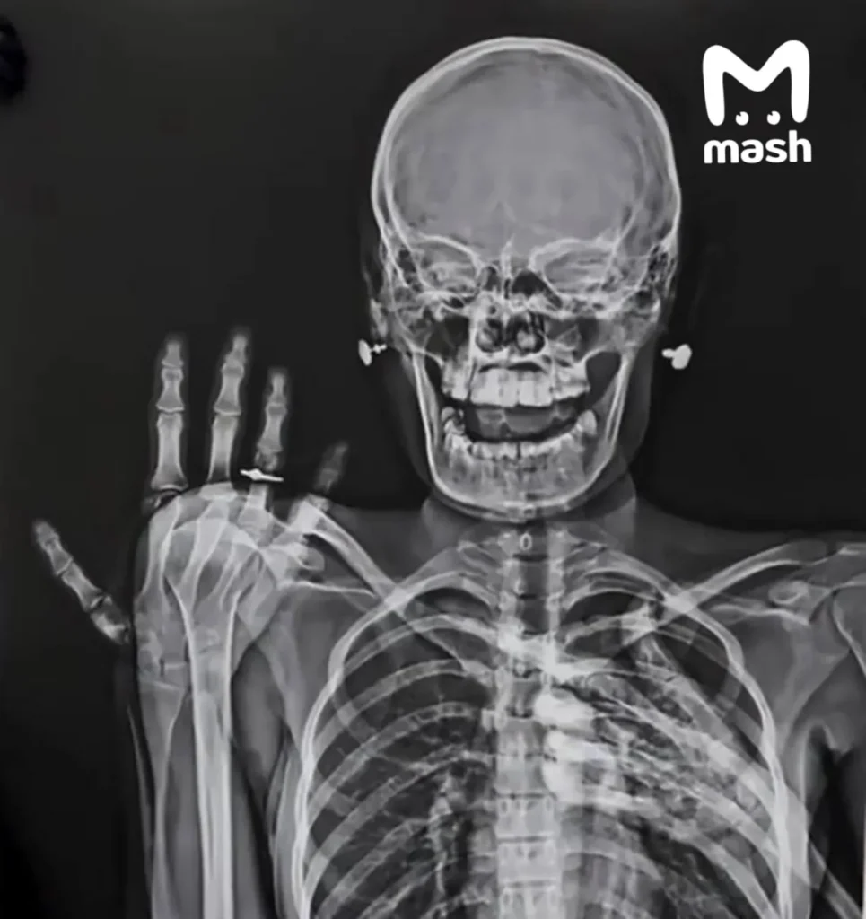 Медики из Новосибирска и Владивостока запустили тренд на рентген с обручальными кольцами