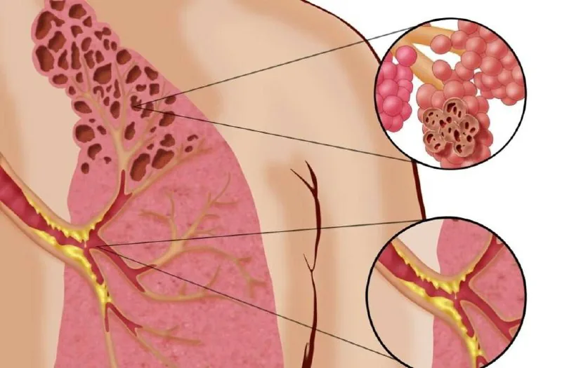 В России за год на 30% выросло число случаев заболеваний лёгких из-за вейпинга
